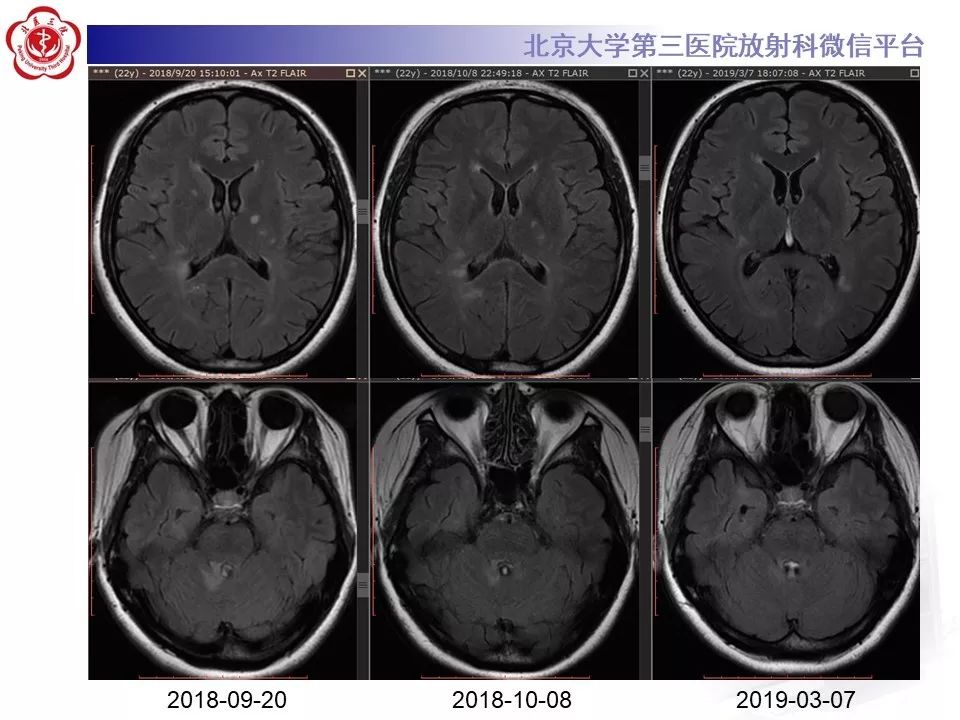 北医三院核磁加急-北医三院做增强核磁的流程 北医三院核磁加急-北医三院做增强核磁的流程