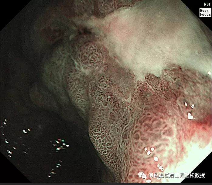慢性胃溃疡镜下图片