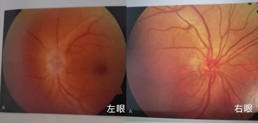 12岁女孩白白服用半年激素假性视神经炎太易误诊