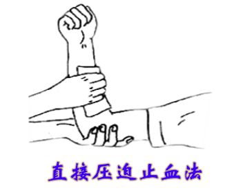 急救 | 创伤救护四项基本原则之止血_压迫
