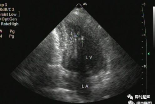 (左室假腱索)八,左心室假腱索有何影响?