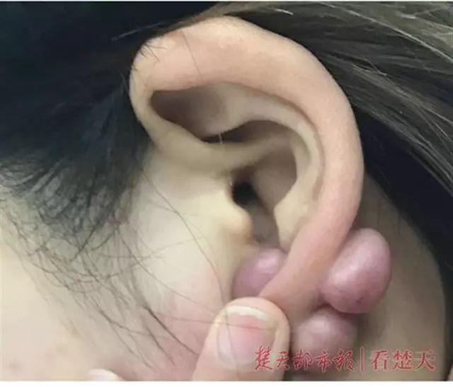 女生双耳长出6个大肉疙瘩只因打了耳钉医生没注意这点就会长