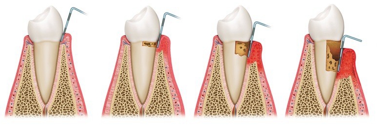 错还以为老掉牙是因为年龄吗真正原因是牙周病