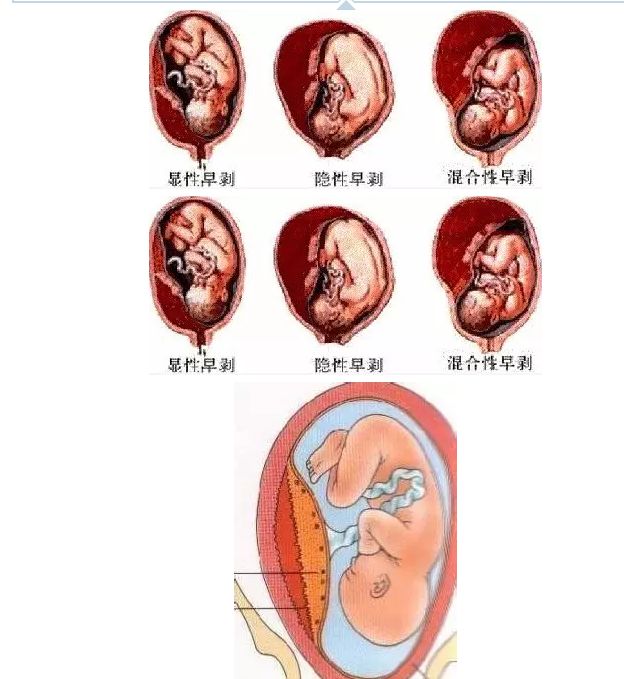 怀孕子宫胎盘位置图图片