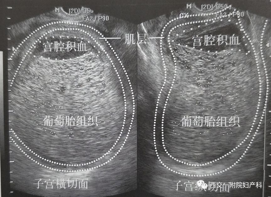 葡萄胎的超声特点