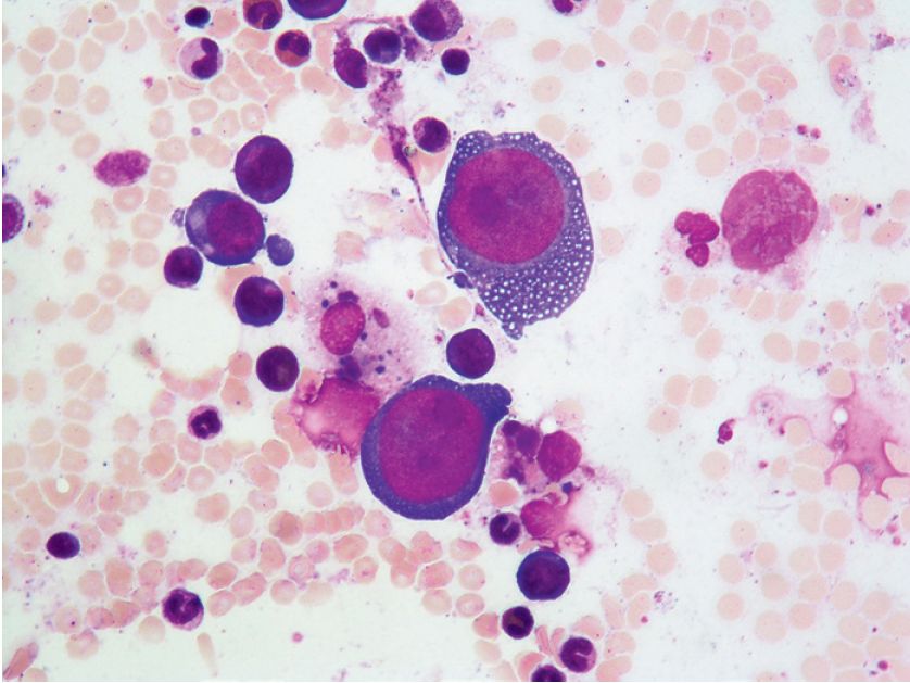 由于其致病机制,常常有纯红再障的表现:外周血网织红细胞细胞明显减少