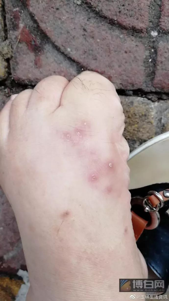 玉林一妹子被蚂蚁咬了一口,10天还没有好