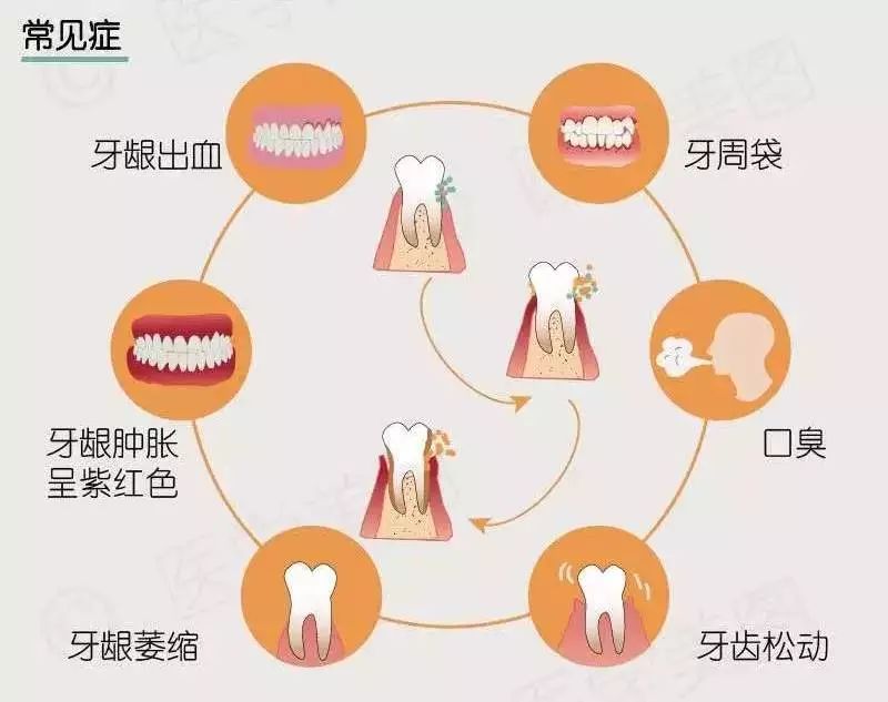 日常刷牙总出血当心牙周炎