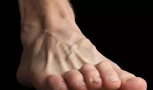 脚趾出现这3种"反常"可能是癌细胞"露出马脚",早发现早控制!