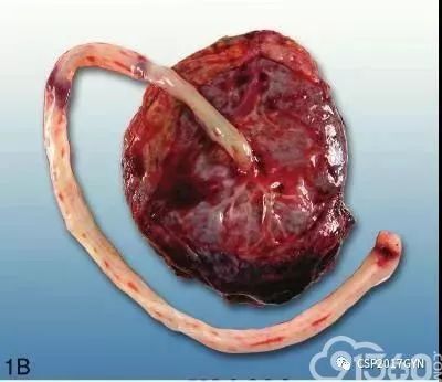 编译:胎盘取材和病变命名 ——amsterdam胎盘工作小组共识(一)_脐带