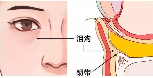 只是把内侧中间的眶膈脂肪团加以游离,转移到泪沟的位置加以缝合固定