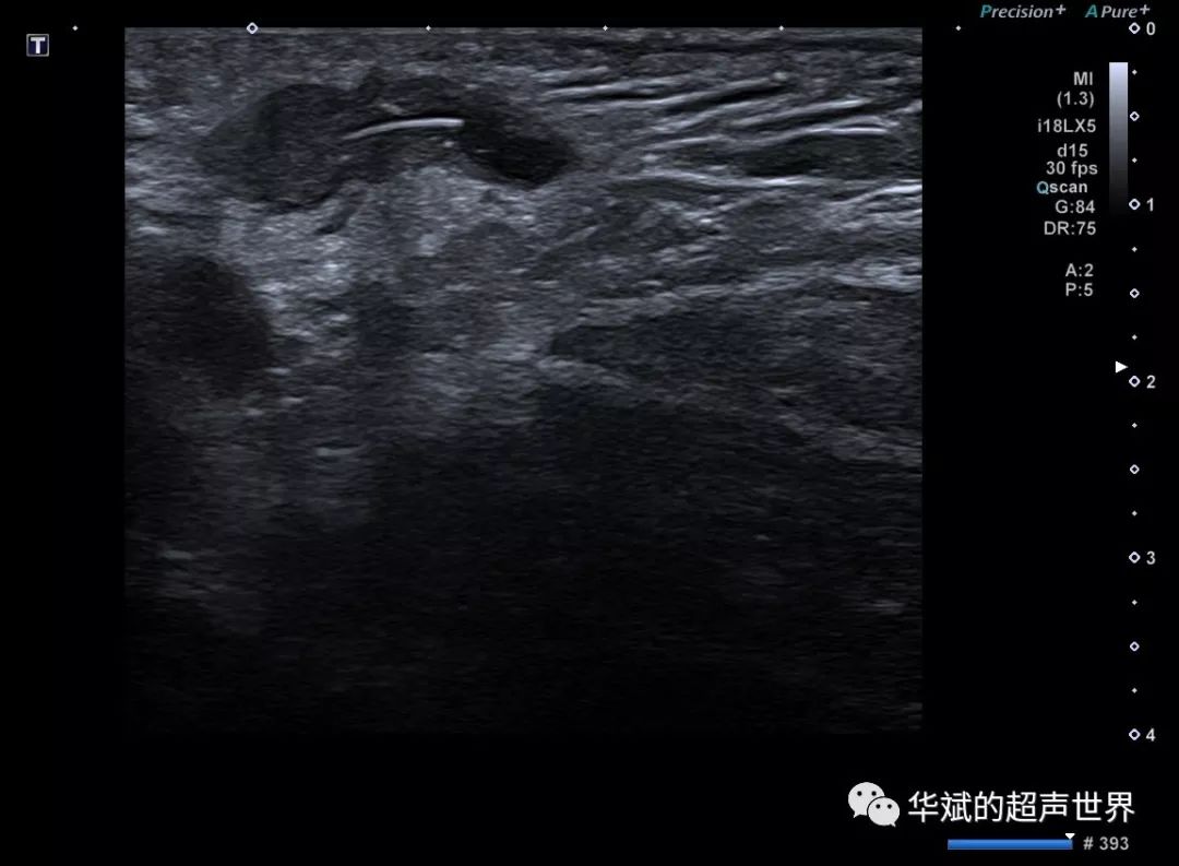 典型病例腋下藏毛囊肿