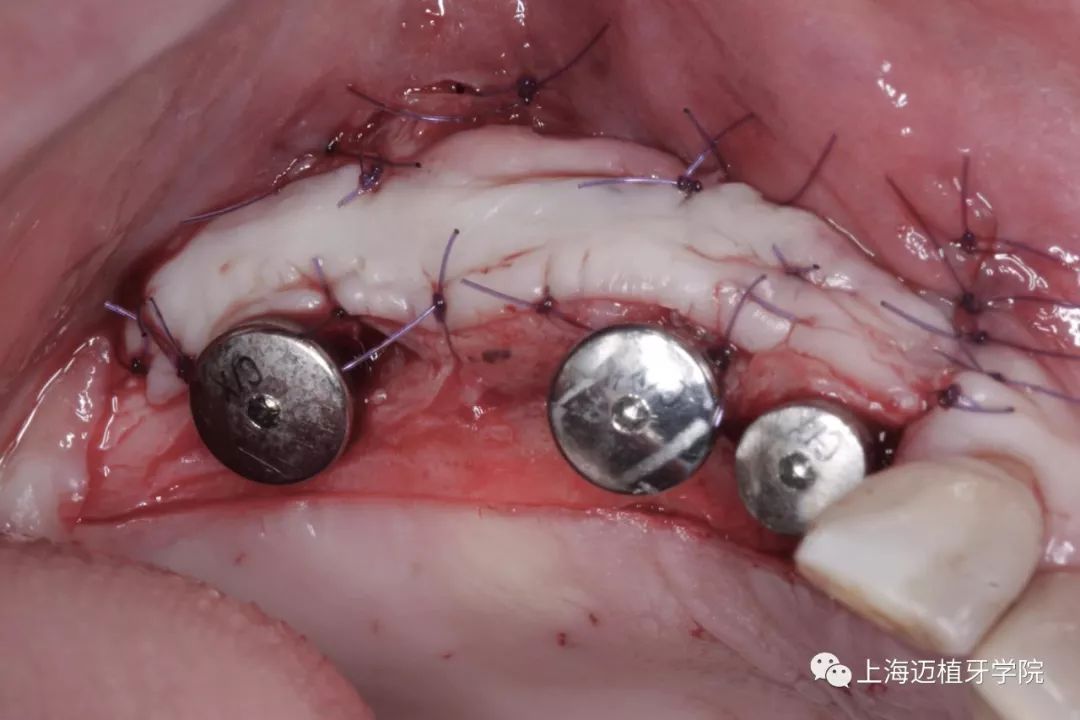 gbr骨生物材料植骨失败后利用bba植骨法及软组织处理病例