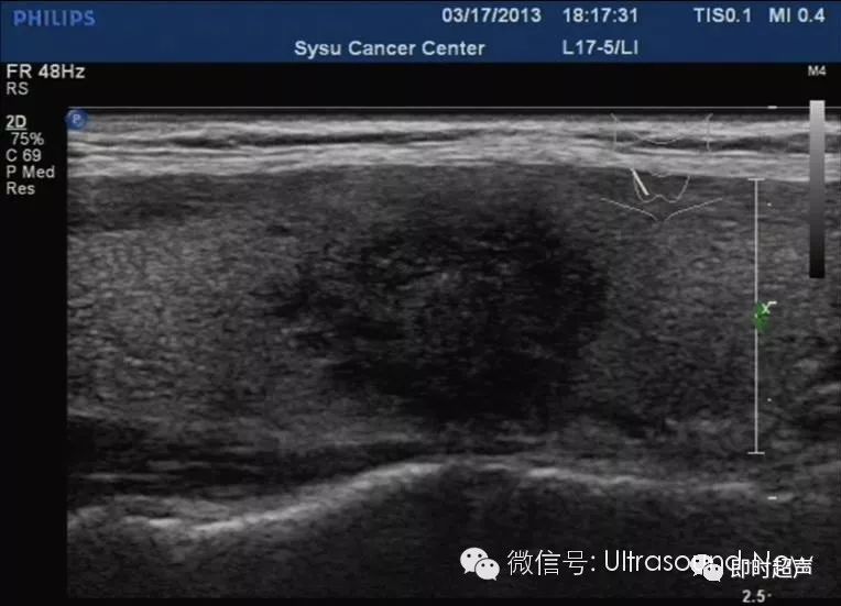 超声声像图如下 a)恶性肿瘤 b)良性肿瘤 c)甲状腺炎?