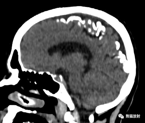 征象丨多系统之轨道征