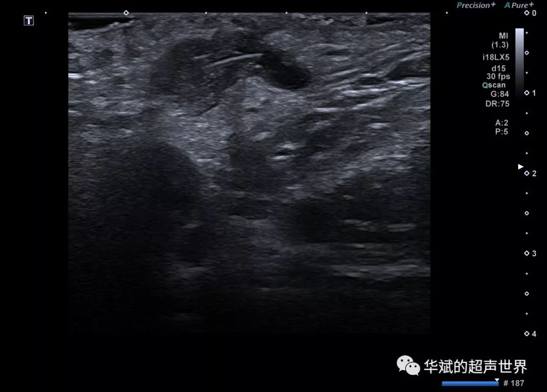 典型病例腋下藏毛囊腫