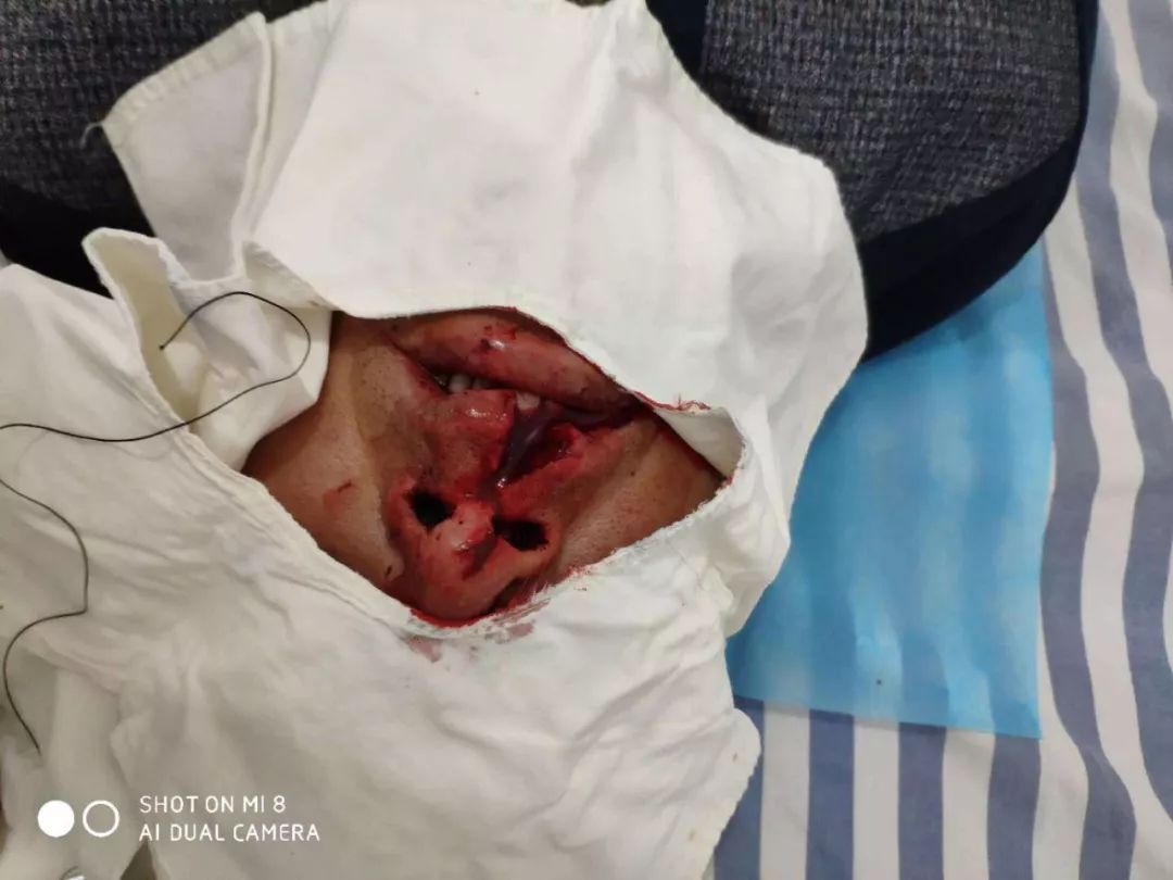 团队与安德镇家庭医生的在成都市郫都区人民医院一位车祸伤患者近日