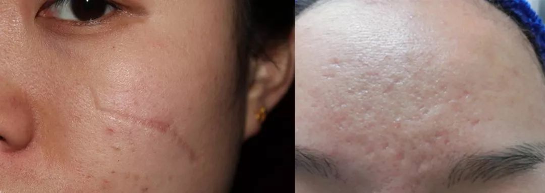 1支搞定痘印疤痕烫伤这款来自西班牙的强大产品竟然不到100元