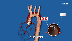 血管不仅会堵,还会爆炸,就问你怕不怕?