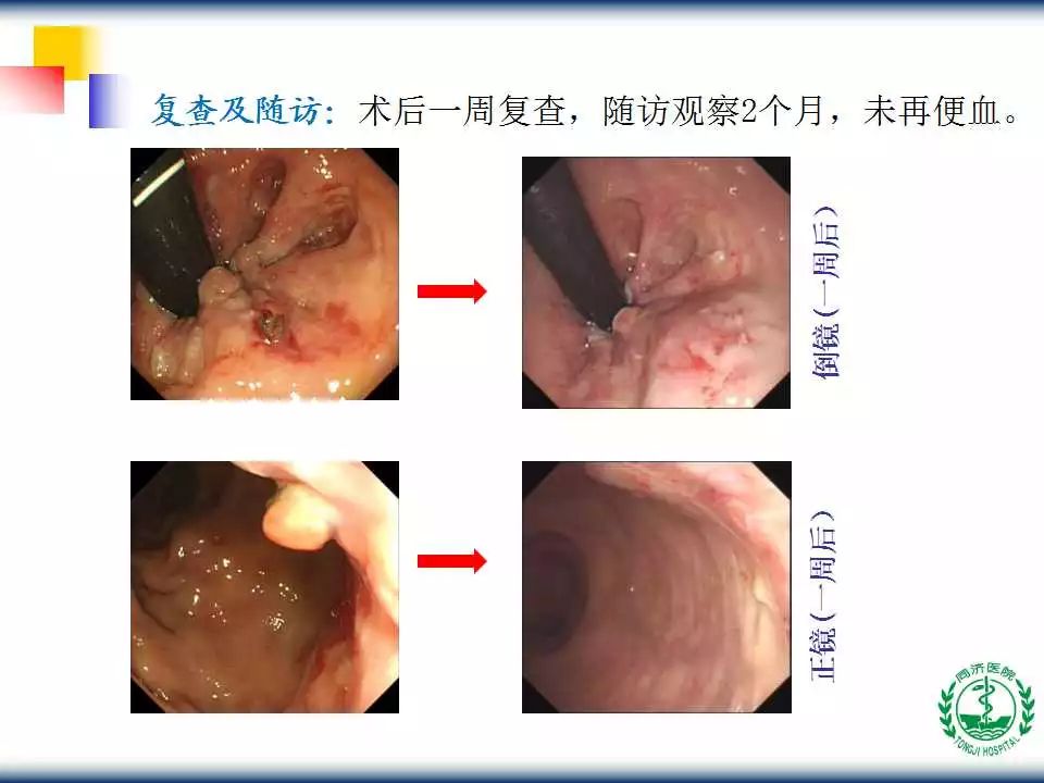 教学ppt内镜下内痔硬化规范化治疗