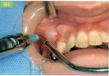 對手術區域進行浸潤麻醉手術區域包括患牙的頰舌側的牙齦槽粘膜以及鄰