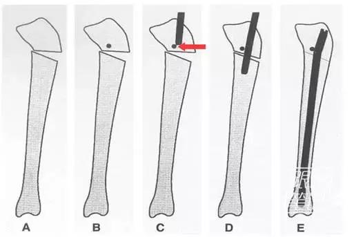 图1图2当在手术过程中发现插入髓内钉骨折复位不佳时,如图3所示,置入