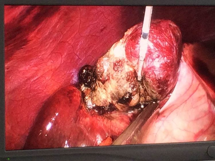 西北首例单孔腹腔镜肝血管瘤微波消融术 (原创)_肿瘤