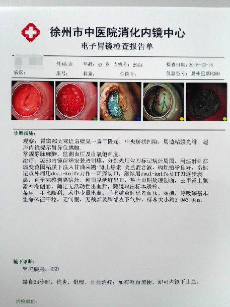 女性 43岁 异位胰腺 esd治疗后 目前恢复良好返回搜狐,查看更多声明
