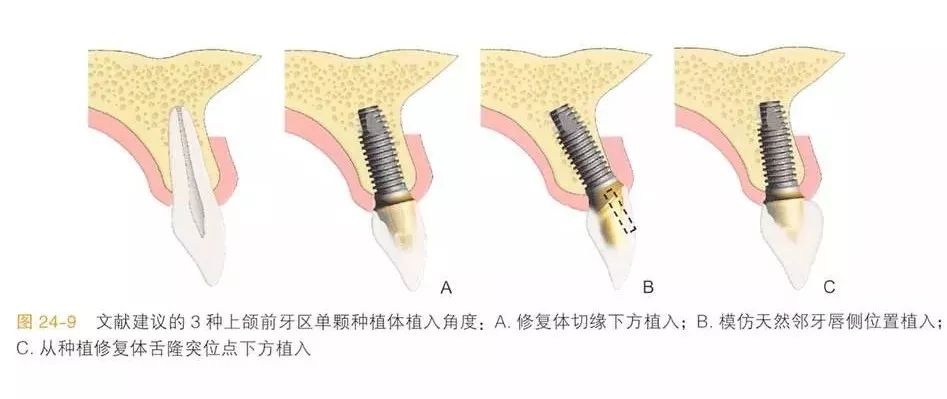 前牙种植体理想的植入位置