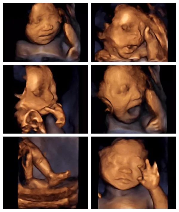 做四维彩超时,你是否也有这些疑惑?