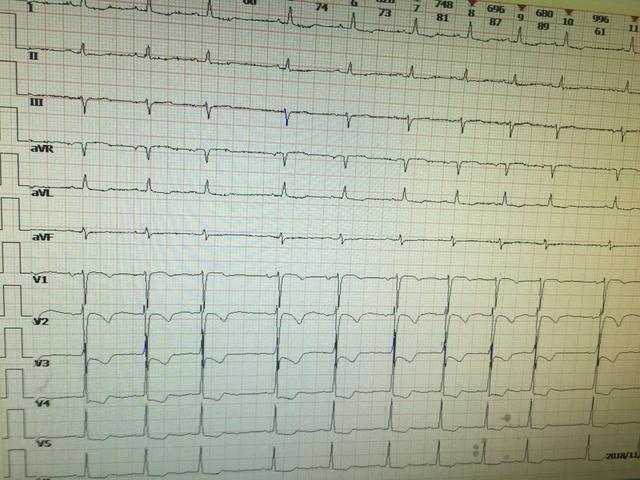 做心电图发现有心肌缺血,该怎么办?