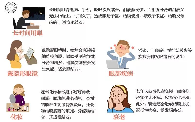 眼睛里也会长结石特别是爱美的女生都有这个风险