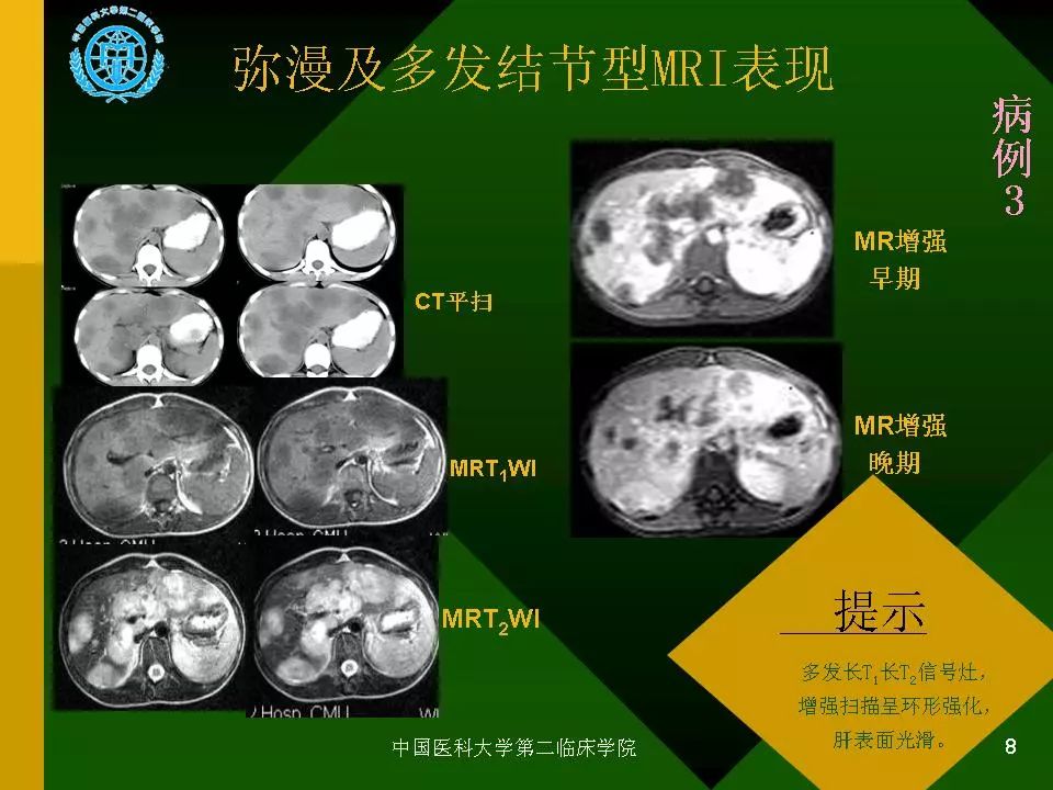 肝脏错构瘤ct图片表现图片