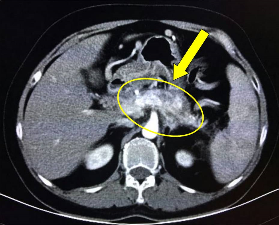 胰颈癌图片