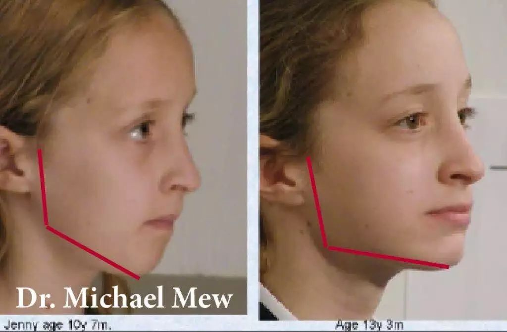 这个10岁的女孩开始下巴有明显向后缩的趋势,经过矫正,3年后,已经完全