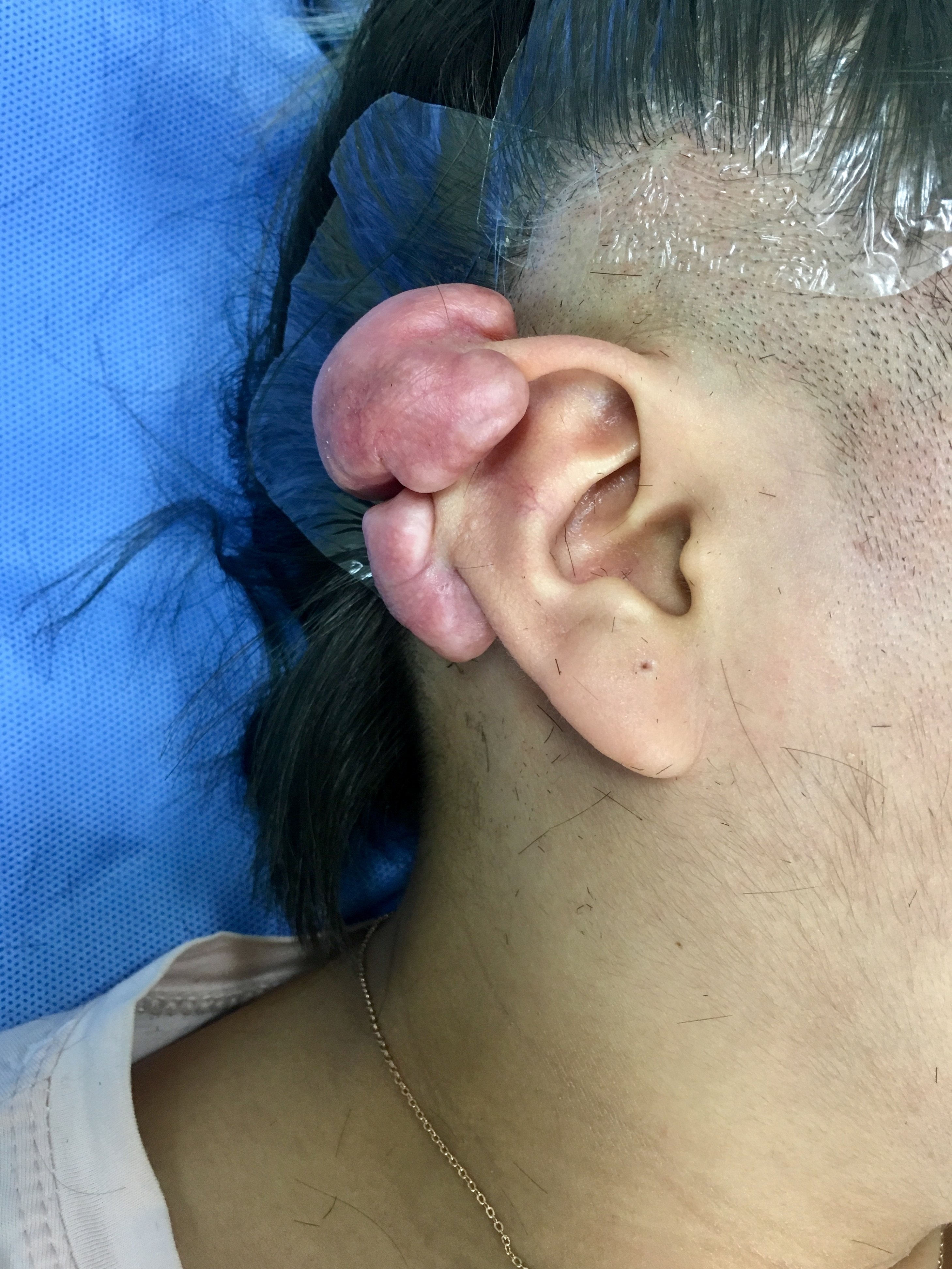 难治性双侧耳廓瘢痕疙瘩的手术治疗 (原创)
