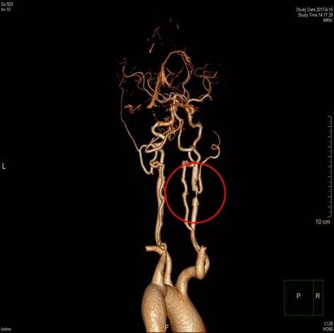 头颈部动脉CTA图片