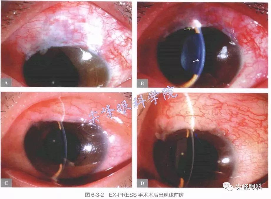 ex-press手术术后同样有大滤泡(伴或不伴浅前房)(图6-3-3).