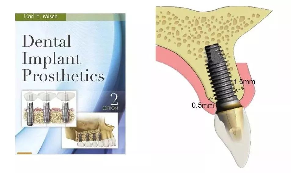 前牙种植体理想的植入位置