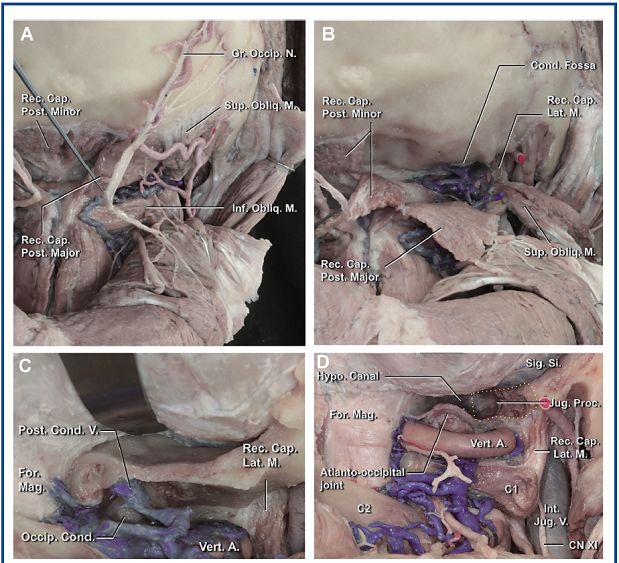 分離肌肉顯露枕骨大孔,髁窩和頭外側直肌;c.