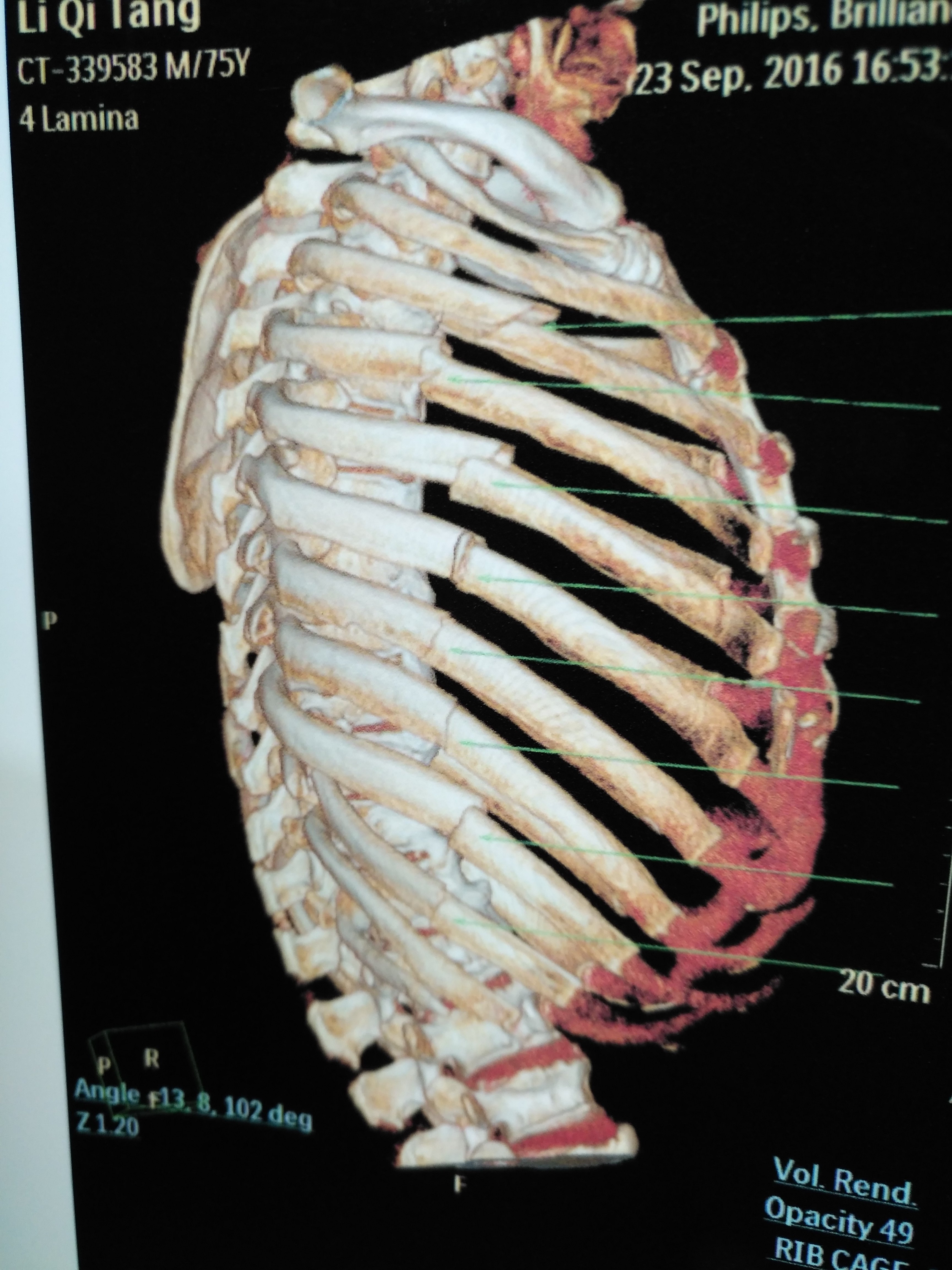 开放性肋骨骨折图片图片