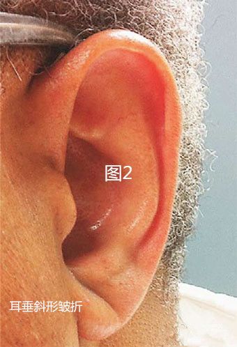 耳垂折痕的真实说法图片