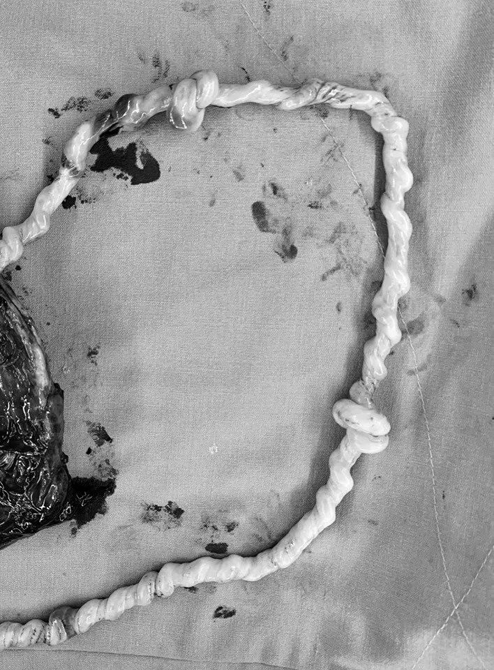 两个死结的脐带谢谢这对父母让我相信会有奇迹