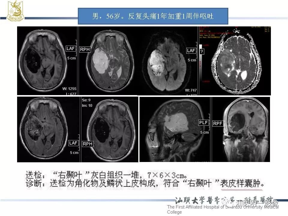 表皮囊肿黑色图片