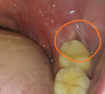 为什么长智齿要拔掉?而不是牙齿矫正呢?医生:它是"绊脚石"