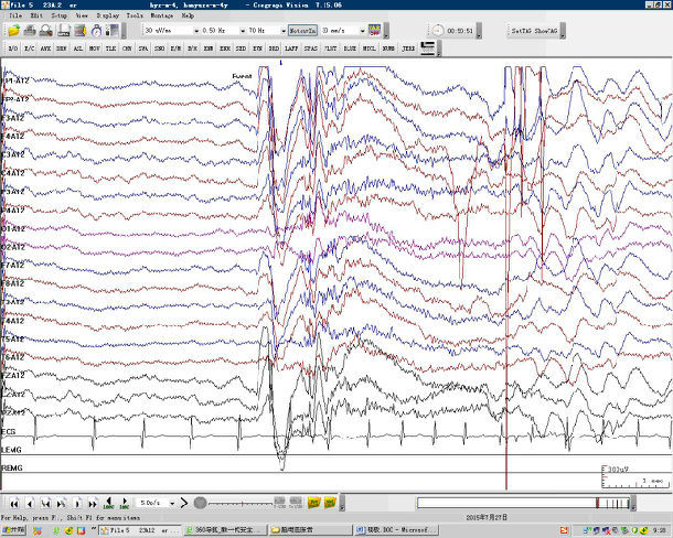 脑电图尖波和棘波图片图片