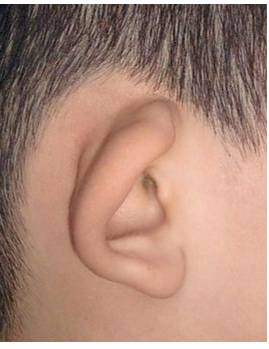 耳轮凹陷图片图片