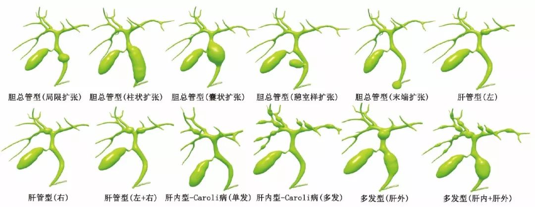 圖5本文提出的膽管擴張症分型方法示意圖綜上所述,由於現有各種分型