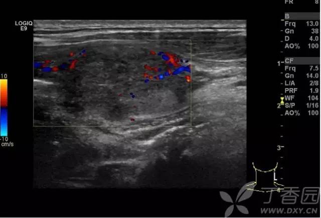 亚甲炎超声表现图像图片