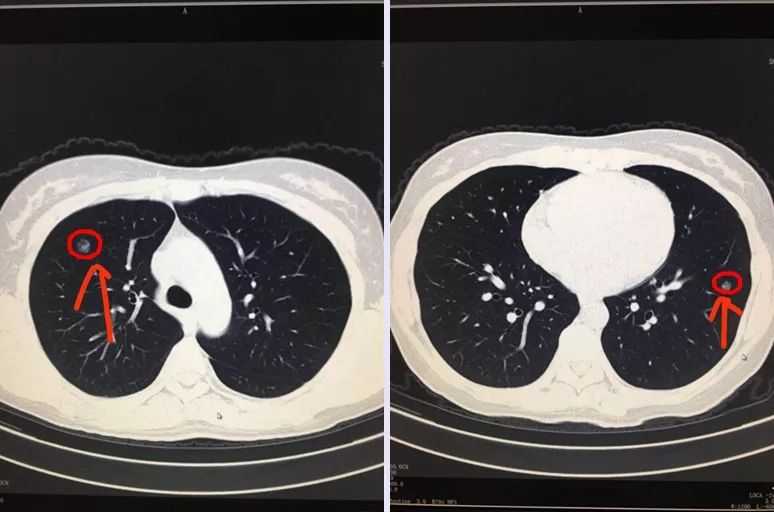 和曹捍波看了她的ct片后,非常肯定应女士患了浸润性腺癌(早期肺癌)